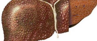 Cirrhosis of the liver