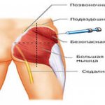 Как правильно самостоятельно колоть уколы в ягодицу