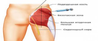 Как правильно самостоятельно колоть уколы в ягодицу