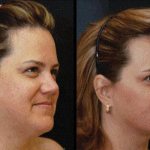 липолитик для лица