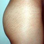 Stretch marks
