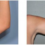 Remove fat from armpits