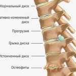 Упражнение планка при грыже позвоночника: можно ли делать, как правильно?
